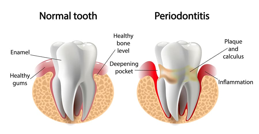 The Connection Between Gum Disease and Dementia